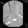 fibrin sheath.jpg (72264 bytes)